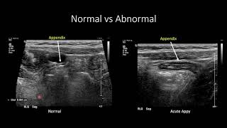 US for Suspected Appendicitis in Children [upl. by Larrad]