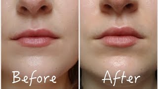 3 Ways To Permanently Enhance Lips Without Lip Injections  Before amp After [upl. by Magnum358]