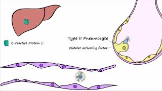 Bacterial Pneumonia  Pathogenesis [upl. by Mali]