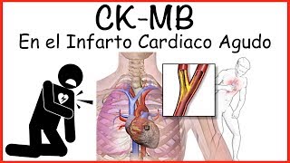 CK MB Uso en Infarto Cardiaco [upl. by Stralka]