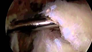 Arthroscopic Rotator Cuff Repair Surgery with SAD Dr Eric Janssen [upl. by Yeaton]