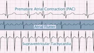 Ventricular Tachycardia ECG  EMTprepcom [upl. by Juback125]