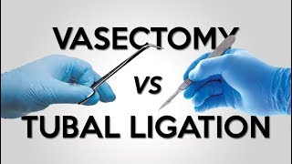 Vasectomy vs Tubal Ligation [upl. by Nodnarb]