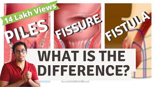 Piles  Fisure  Fistula  Difference explained  Dr Vishal Tomar  Open Consult [upl. by Nnaycnan846]