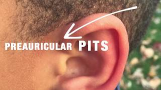 Treatment of Auricular Hematoma [upl. by Pigeon67]