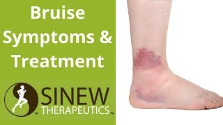 Bruise Symptoms and Treatment [upl. by Atsahs]