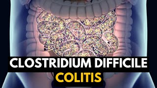 CLOSTRIDIUM DIFFICILE COLITIS Causes Signs and Symptoms Diagnosis and Treatment [upl. by Aleece]