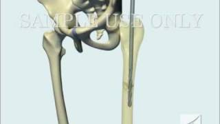 Femoral Fracture Fixation Surgery Intramedullary Nail [upl. by Aitnahc]