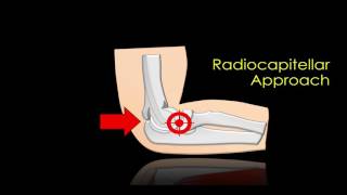 Hip Steroid Injection Technique with Fluoroscopic Guidance [upl. by Kin]