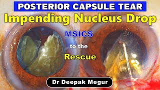 Impending Nucleus Drop  P C tear Aborting Phaco and Converting to MSICS  Dr Deepak Megur [upl. by Eppie]