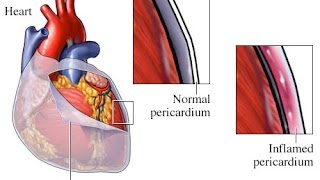 Pericarditis [upl. by Fradin24]