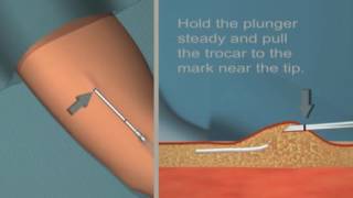 Jadelle insertion and removal Tutorial [upl. by Wright]