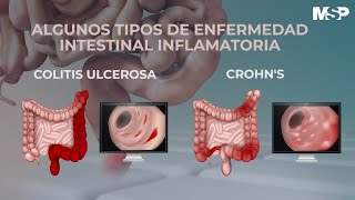 ¿Cómo tratar las enfermedades inflamatorias del intestino  ExclusivoMSP [upl. by Ardle]