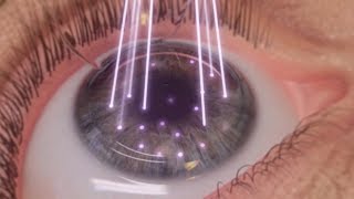 Relex smile vs lasik laser eye surgery [upl. by Yalhsa298]