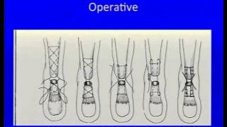 Acute Achilles Tendon Rupture Instructional Lecture and Debates [upl. by Notsae916]