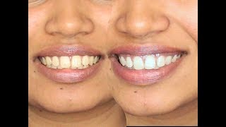 How to Whiten Teeth  DIY  Turmeric and Coconut oil [upl. by Nhabois]