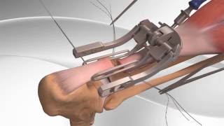 Achilles Tendon Rupture Repair with Arthrex® PARS System [upl. by Nealy]