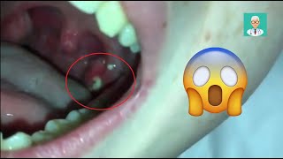 Tonsil Stone Removal by ENT Doctor  Medic4arab 😨🔥 [upl. by Ainnos422]