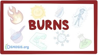 Burns  an Osmosis Preview [upl. by Eenehs]