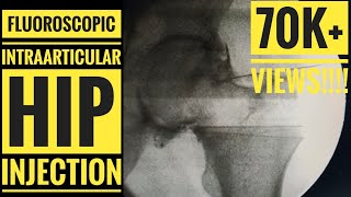 Fluoroscopic loop demonstrates axillary access [upl. by Eledoya607]