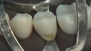 Class V Composite Preparation amp Restoration  Operative Dentistry [upl. by Wales]