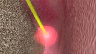 Laser Periodontal Therapy  WPT™ Animation [upl. by Nelrsa823]