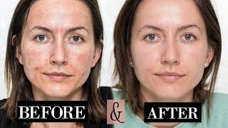 My MICRONEEDLING Experience  Skin Updates  Before amp After [upl. by Niamjneb]