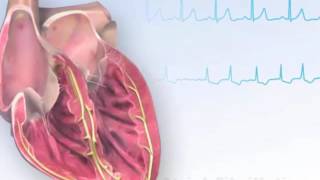 American Heart Association AHA Atrial Fibrillation Animation [upl. by Frodin698]