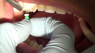 root canal treatment part 1 [upl. by Juliann]