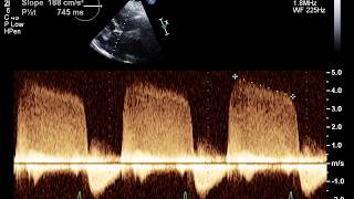 Aortic Regurgitation Key signs in 60 seconds [upl. by Mastrianni302]