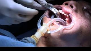 Submental Orotracheal Intubation in Severe Facial Trauma [upl. by Navonod]