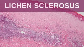 Lichen Sclerosus  Pathology mini tutorial [upl. by Haugen]