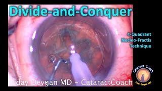 Divide and Conquer Phaco Technique for Cataract Surgery [upl. by Aronoel]