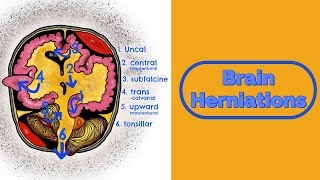 Brain Herniations and Raised ICP [upl. by Nwahser]