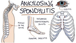 Ankylosing Spondylitis Visual Explanation for Students [upl. by Adnalro]