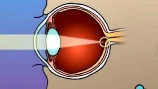 How LASIK Eye Surgery or Laser Eye Surgery Works [upl. by Nally]