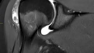 Bursitis of shoulder  First Look MRI [upl. by Kristy428]