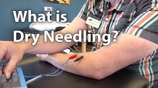 What is Dry Needling [upl. by Ynnahc]