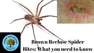 Brown Recluse Spider Bites What you need to know [upl. by Yttel720]