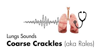 Coarse Crackles Rales  Lung Sounds  Medzcool [upl. by Durer773]