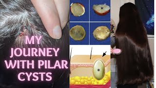 My Journey with Pilar Cysts on my Scalp  Removal  Aftercare VLOG [upl. by Caritta470]