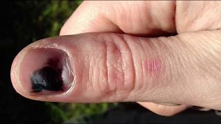 Bruised Thumbnail Growing Out Time Lapse [upl. by Eniala]