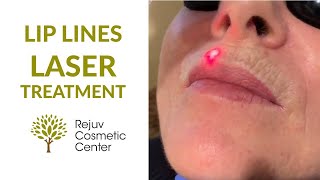 Lip Lines Sciton LaserTreatment Rejuv Cosmetic Center NJ [upl. by Noreht260]