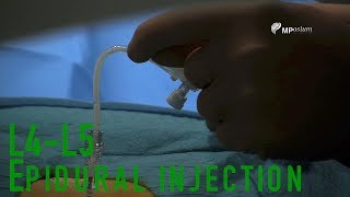 L4L5 epidural injection [upl. by Arahsat]