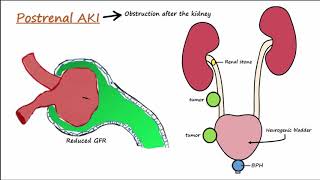 Acute Kidney Injury AKI  PrerenalIntrarenalPostrenal [upl. by Rothenberg821]