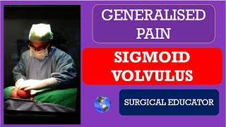 SIGMOID VOLVULUS How To DIAGNOSE amp TREAT Generalised Abdominal Pain [upl. by Beauvais484]