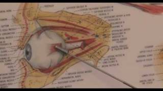 LASIK Eye Surgery for Astigmatism with LasikPlus [upl. by Etteyafal]