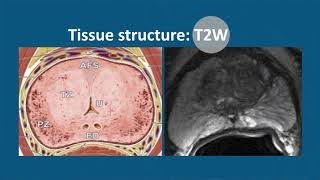 Multiparametric MRI to Detect Clinically Significant Prostate Cancer What Urologists Need to Know [upl. by Eirlav]