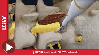 L5S1 Lumbar Discectomy and Fusion Surgery 3D animation [upl. by Diogenes]