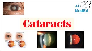 Cataracts  Causes Risk factors Subtypes Cortical Nuclear Posterior subcapsular Treatment [upl. by Eeldivad]